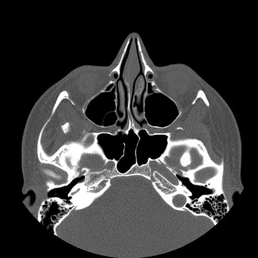 Aneurysmal bone cyst of the mandible (Radiopaedia 43280-46823 Axial bone window 149).jpg