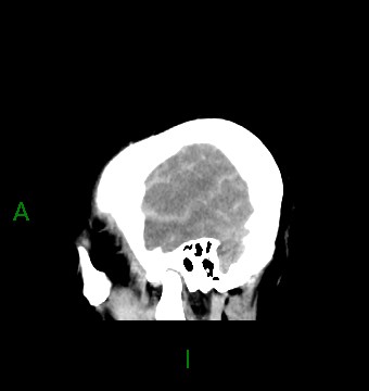 File:Aneurysmal subarachnoid hemorrhage with intra-axial extension (Radiopaedia 84371-99699 B 7).jpg