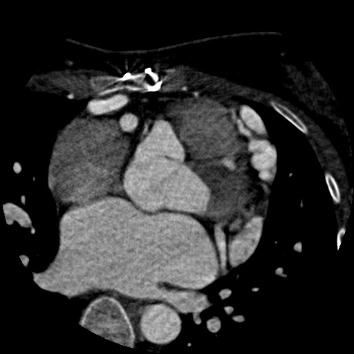 File:Anomalous left coronary artery from the pulmonary artery (ALCAPA) (Radiopaedia 40884-43586 A 28).jpg