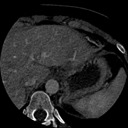 File:Anomalous left coronary artery from the pulmonary artery (ALCAPA) (Radiopaedia 40884-43586 A 91).jpg