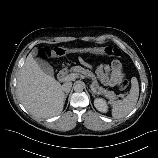 File:Anomalous origin of the left coronary artery with malignant course (Radiopaedia 77842-90126 Axial non-contrast 36).jpeg