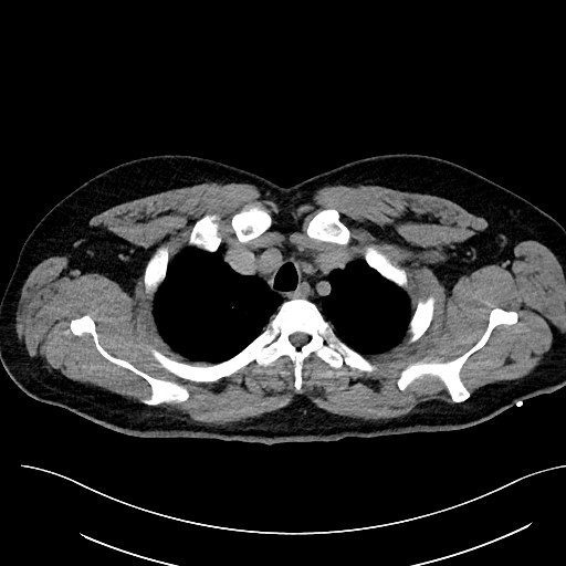 File:Anomalous origin of the left coronary artery with malignant course (Radiopaedia 77842-90126 Axial non-contrast 7).jpeg