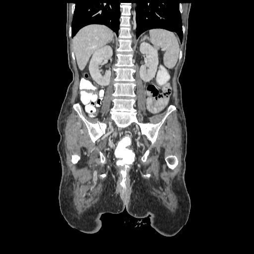 Anorectal carcinoma (Radiopaedia 44413-48064 B 56).jpg