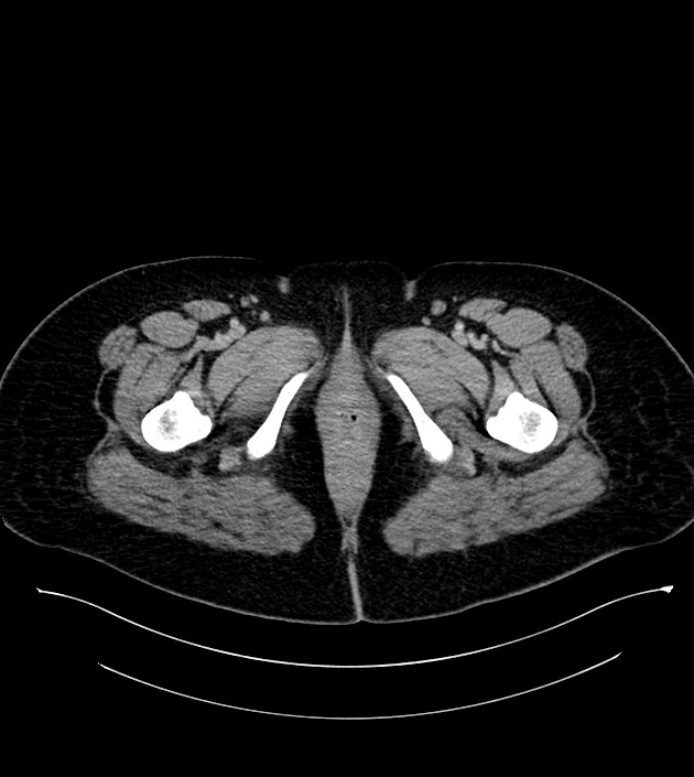 Anterior abdominal wall CSF pseudocyst (CSFoma) (Radiopaedia 79453-92571 A 98).jpg