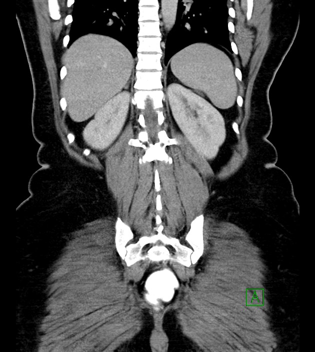 Anterior abdominal wall CSF pseudocyst (CSFoma) (Radiopaedia 79453-92571 B 43).jpg