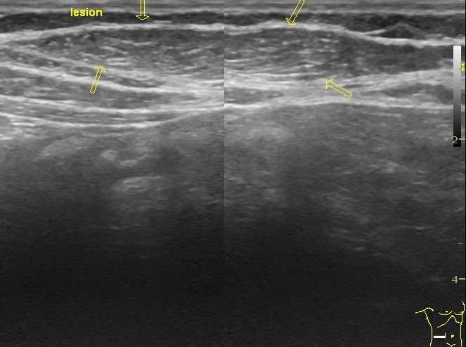 File:Anterior abdominal wall lipoma (Radiopaedia 9283-9966 B 1).jpg