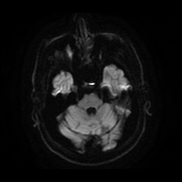 Anterior cerebral artery infarction (Radiopaedia 46794-51323 Axial DWI 9).jpg