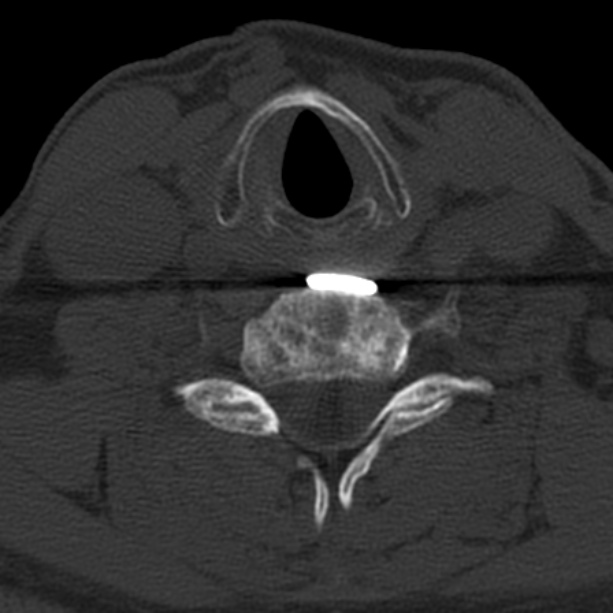 Anterior cervical postdiscectomy arthrodesis (Radiopaedia 32678-33646 Axial bone window 53).jpg