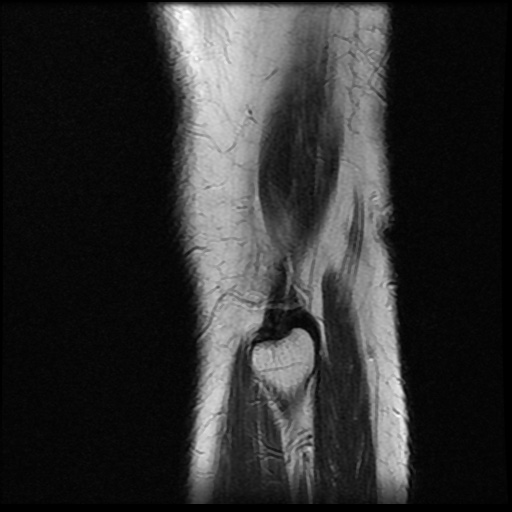 File:Anterior cruciate ligament avulsion fracture (Radiopaedia 58939-66193 Sagittal T2 2).jpg