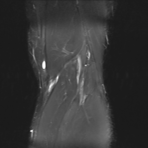 File:Anterior cruciate ligament full thickness tear (Radiopaedia 66268-75467 Coronal STIR 20).jpg