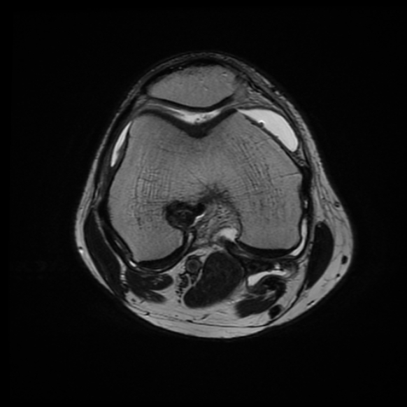 File:Anterior cruciate ligament graft tear and bucket-handle tear of medial meniscus (Radiopaedia 75867-87255 Axial T2 14).jpg