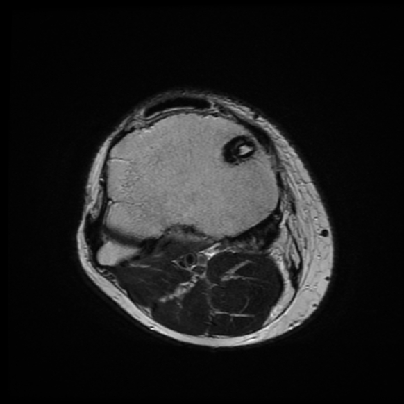 File:Anterior cruciate ligament graft tear and bucket-handle tear of medial meniscus (Radiopaedia 75867-87255 Axial T2 3).jpg