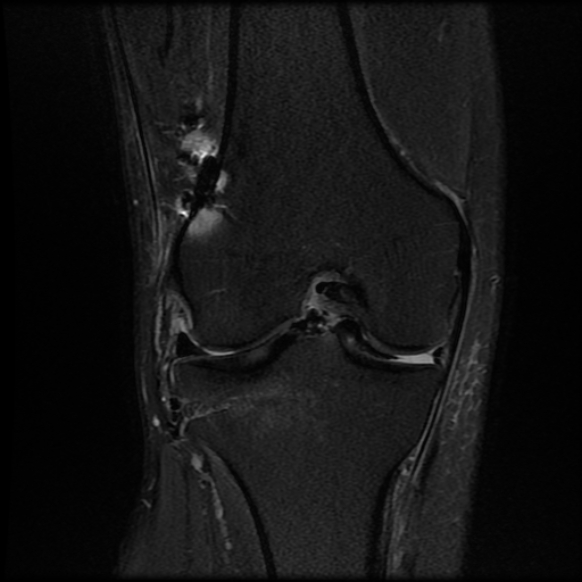 File:Anterior cruciate ligament graft tear and bucket-handle tear of medial meniscus (Radiopaedia 75867-87255 Coronal PD fat sat 15).jpg