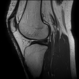 File:Anterior cruciate ligament rupture and posteromedial corner injury (Radiopaedia 67338-76723 Sagittal PD 107).jpg