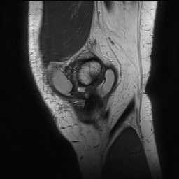 Anterior cruciate ligament rupture with Segond fracture (Radiopaedia 69043-78806 Sagittal PD 31).jpg