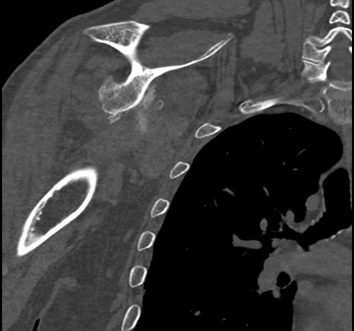 Anterior glenohumeral dislocation with Hill-Sachs lesion (Radiopaedia 62877-71249 Coronal bone window 64).jpg