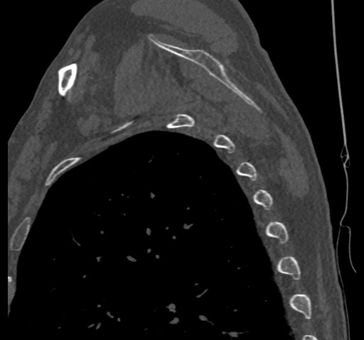 Anterior glenohumeral dislocation with Hill-Sachs lesion (Radiopaedia 62877-71249 Sagittal bone window 56).jpg