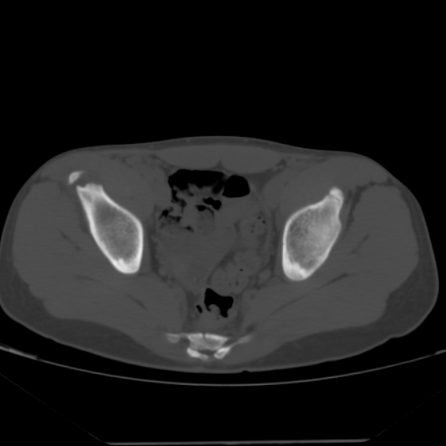 Anterior inferior iliac spine avulsion fracture (Radiopaedia 49469-54627 Axial bone window 30).jpg
