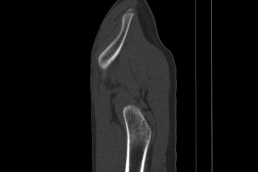 Anterior inferior iliac spine avulsion injury (Radiopaedia 88666-105376 Sagittal bone window 85).jpg