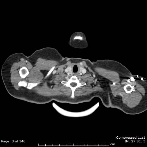 Anterior mediastinal B cell Lymphoma (Radiopaedia 50677-56114 A 2).jpg