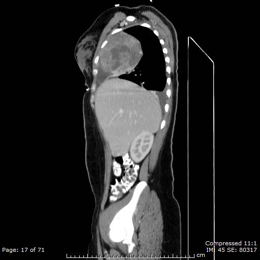 File:Anterior mediastinal B cell Lymphoma (Radiopaedia 50677-56114 C 9).jpg