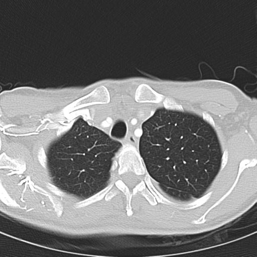 Anterior mediastinal lymphoma (Radiopaedia 29556-30061 Axial lung window 10).jpg