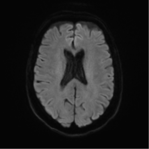 File:Anterior temporal pole cysts (Radiopaedia 46629-51102 Axial DWI 44).png