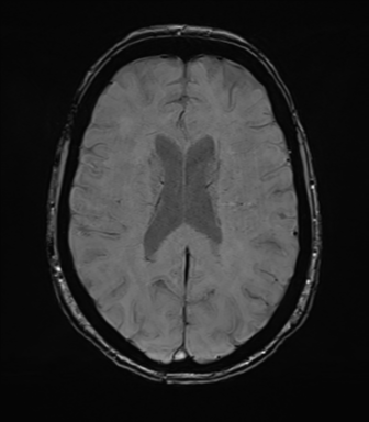 Anterior temporal pole cysts (Radiopaedia 46629-51102 Axial SWI 54).png