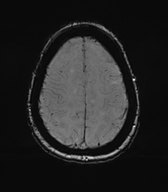 Anterior temporal pole cysts (Radiopaedia 46629-51102 Axial SWI 70).png
