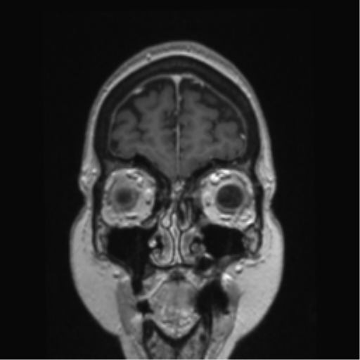 Anterior temporal pole cysts (Radiopaedia 46629-51102 Coronal T1 C+ 150).png