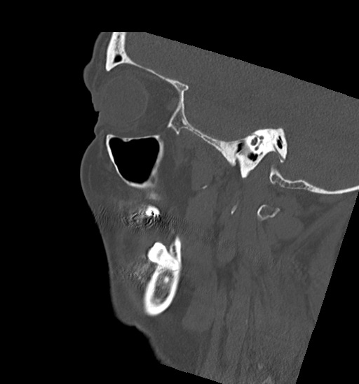 Anterior temporomandibular joint dislocation (Radiopaedia 59430-66784 B 16).jpg