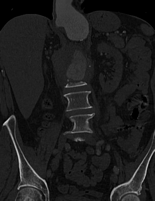 Anterior vertebral scalloping (abdominal aortic aneurysm) (Radiopaedia 66744-76067 Coronal bone window 25).jpg
