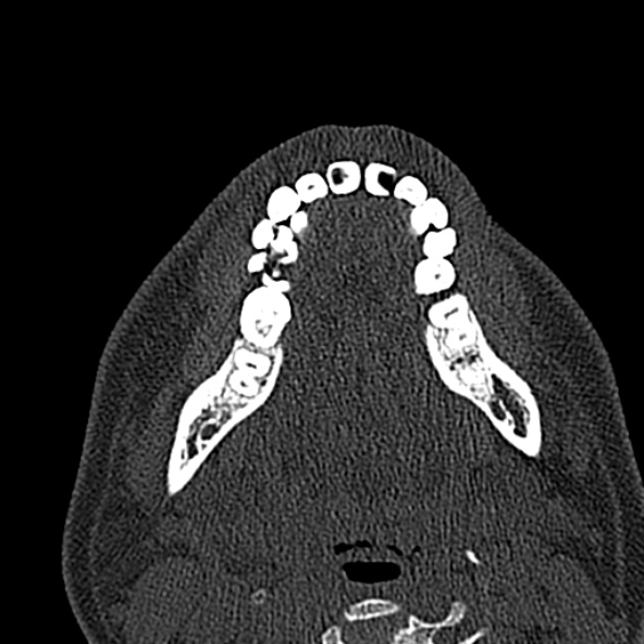 Antrochoanal polyp (Radiopaedia 30002-30554 Axial bone window 6).jpg
