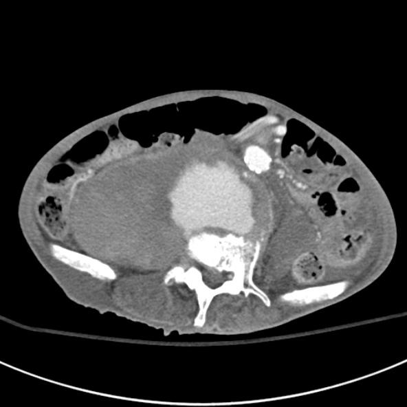 File:Aortic aneurysm with spinal destruction (Radiopaedia 42301-45410 A 63).jpg
