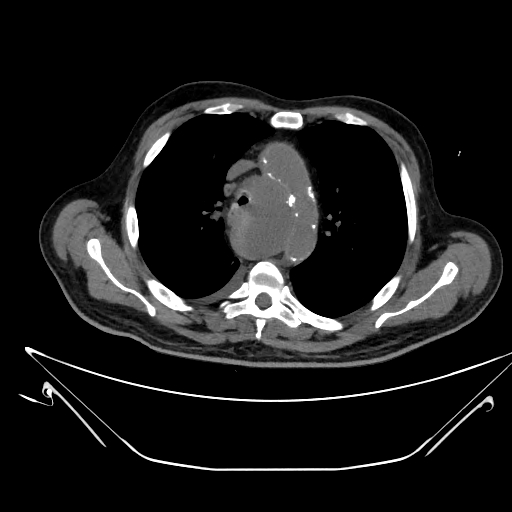 Aortic arch aneurysm (Radiopaedia 84109-99365 Axial non-contrast 101).jpg