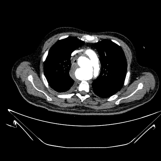 Aortic arch aneurysm (Radiopaedia 84109-99365 B 200).jpg