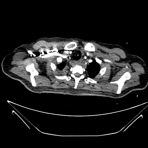 Aortic arch aneurysm (Radiopaedia 84109-99365 B 77).jpg
