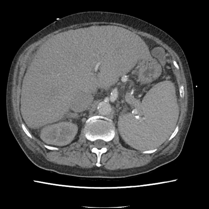 Aortic arch graft infection (FDG PET-CT) (Radiopaedia 71975-82437 A 66).jpg