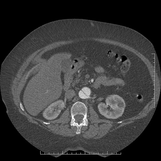 Aortic dissection- Stanford A (Radiopaedia 35729-37268 B 62).jpg