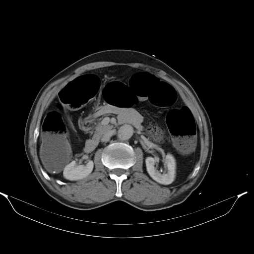 File:Aortic dissection- Stanford type A (Radiopaedia 22085-22085 Axial C+ delayed 21).jpg
