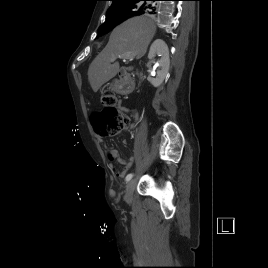 Aortic dissection (CTPA) (Radiopaedia 75506-86750 G 34).jpg