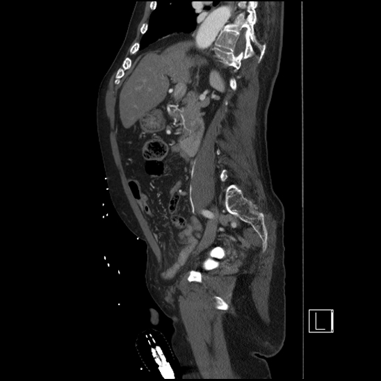 Aortic dissection (CTPA) (Radiopaedia 75506-86750 G 42).jpg