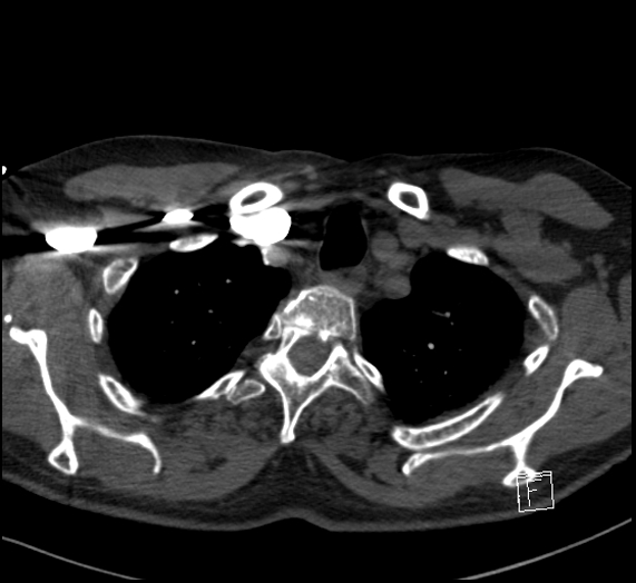 File:Aortic dissection (CTPA) (Radiopaedia 75506-86751 Axial C+ CTPA 21).jpg