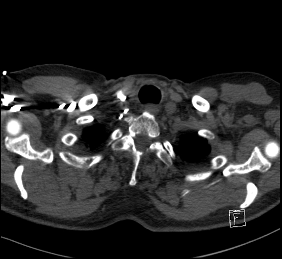 File:Aortic dissection (CTPA) (Radiopaedia 75506-86751 Axial C+ CTPA 9).jpg