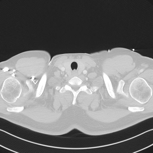 File:Aortic dissection (Radiopaedia 50763-56234 Axial lung window 7).png