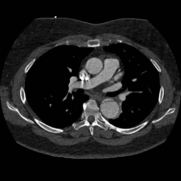 Aortic dissection (Radiopaedia 57969-64959 A 144).jpg