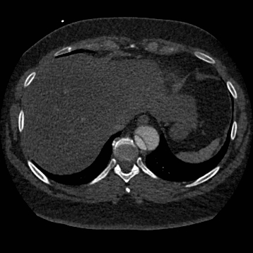 File:Aortic dissection (Radiopaedia 57969-64959 A 253).jpg