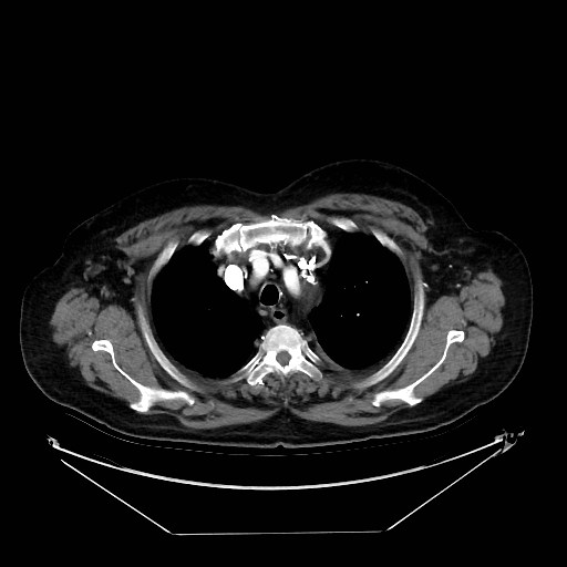 Aortic dissection (Radiopaedia 62562-71000 A 2).jpg