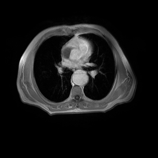 File:Aortic dissection - Stanford A - DeBakey I (Radiopaedia 23469-23551 Axial MRA 18).jpg