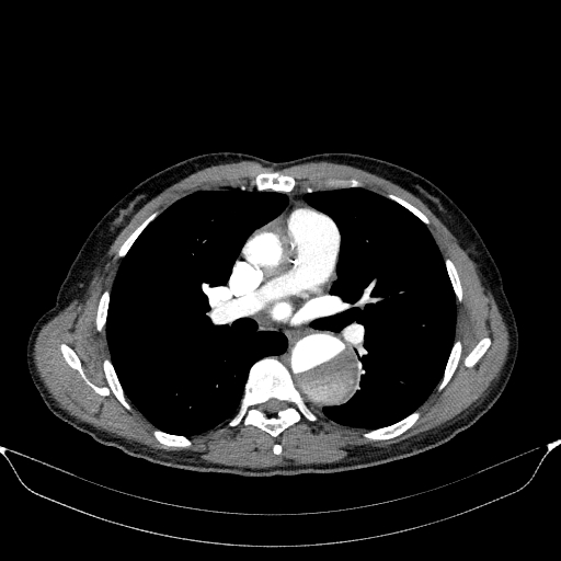 File:Aortic dissection - Stanford type A (Radiopaedia 83418-98500 A 31).jpg